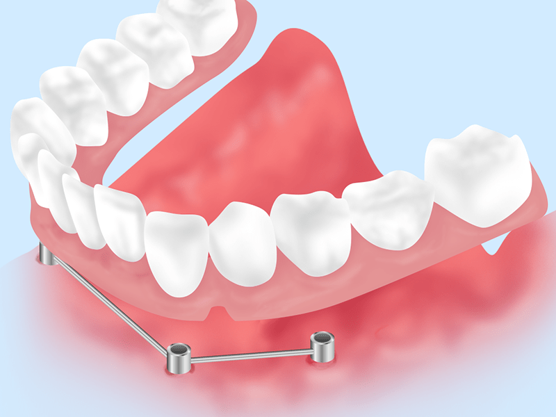 より安定感の高い入れ歯「インプラントデンチャー」