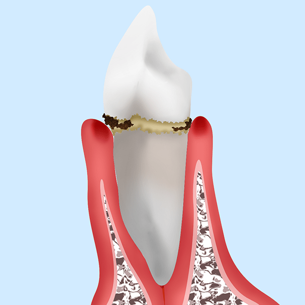 【歯肉炎】