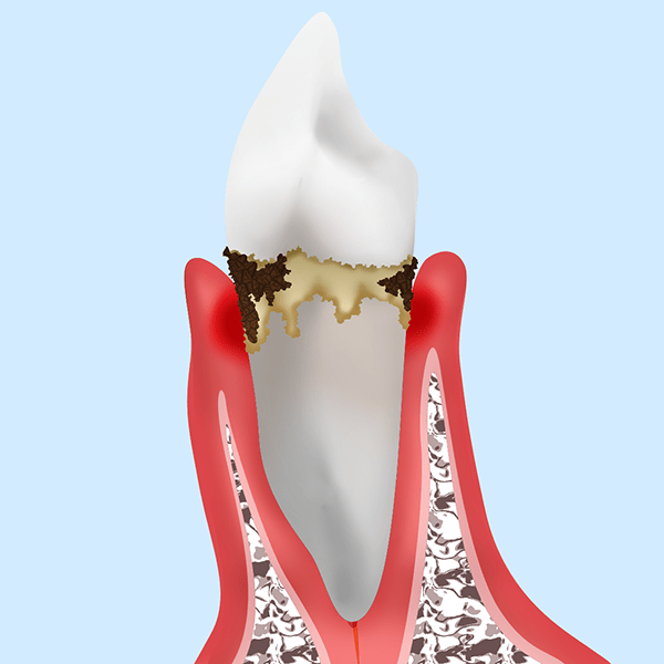 【軽度歯周病】