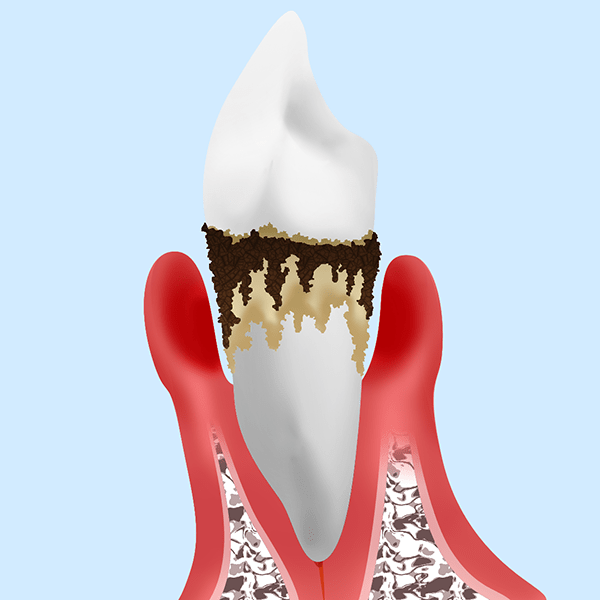 【重度歯周病】