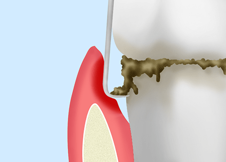 歯周ポケット掻爬(そうは)術