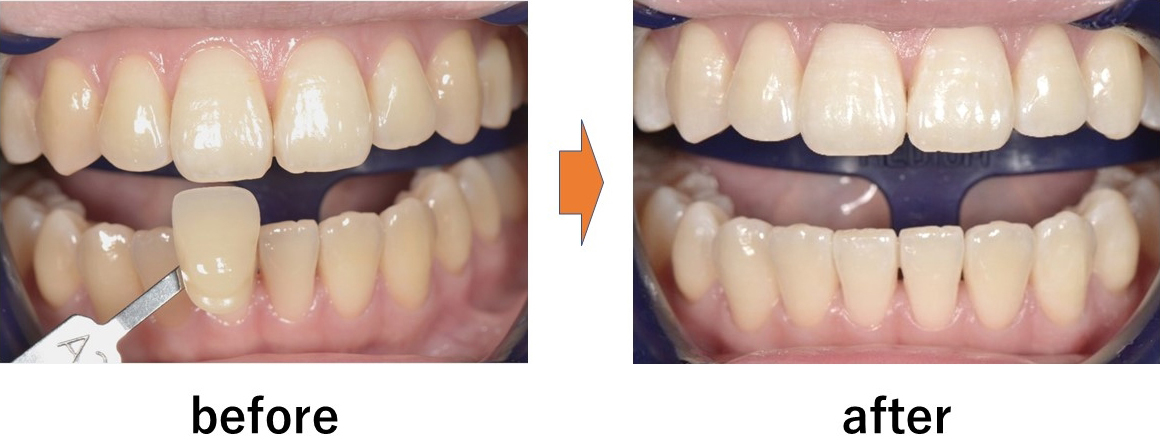 オフィスホワイトニングの症例