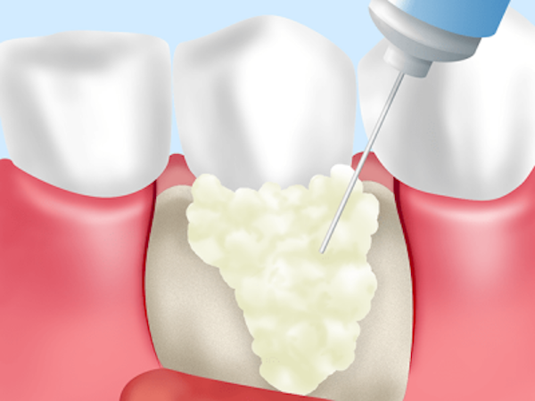歯周組織再生治療について