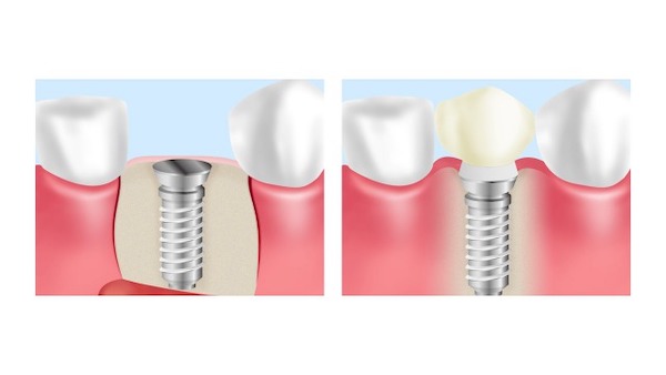 京橋 銀座みらい歯科のインプラントの説明で使用するインプラントの構造についての画像