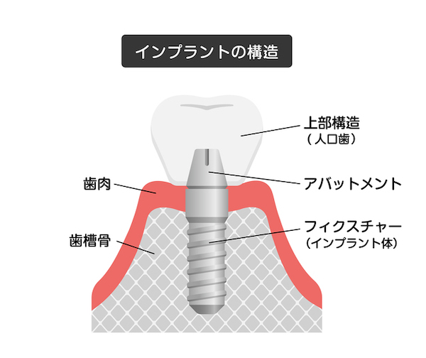 京橋 銀座みらい歯科のブログ＿インプラントの構造図