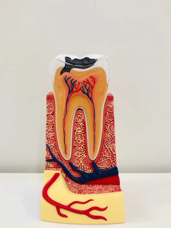 京橋 銀座みらい歯科＿虫歯菌によって虫歯になってしまった歯の断面図の精巧な模型