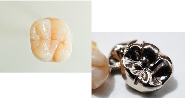 京橋 銀座みらい歯科の虫歯治療で使用する白いセラミックの被せ物と金属の被せ物