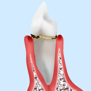 京橋 銀座みらい歯科の歯肉炎の説明＿歯と歯茎の間に汚れがたまった歯のイメージ