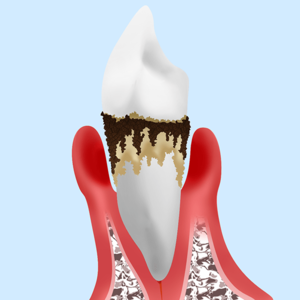京橋 銀座みらい歯科の歯周病の説明＿歯周組織の炎症で骨が溶けてしまった歯のイメージ