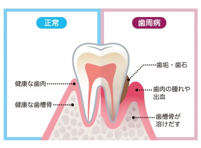 京橋 銀座みらい歯科のブログで説明する健康な歯周組織と歯槽骨、歯周病の歯周組織と歯槽骨の比較図
