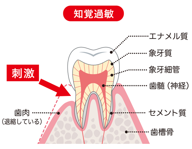 京橋 銀座みらい歯科 歯がしみる知覚過敏についてのブログ 歯がしみる仕組みの図