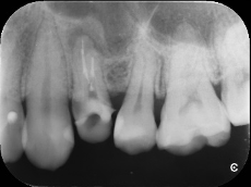 【症例】歯の根管内の異物除去について