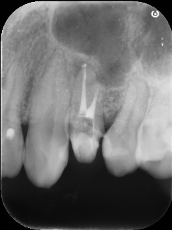 【症例】歯の根管内の異物除去について