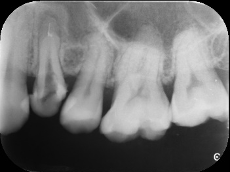 【症例】歯の根管内の異物除去について