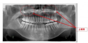 京橋 銀座みらい歯科歯性上顎洞炎と副鼻腔炎 上顎洞と上顎の位置関係レントゲン画像