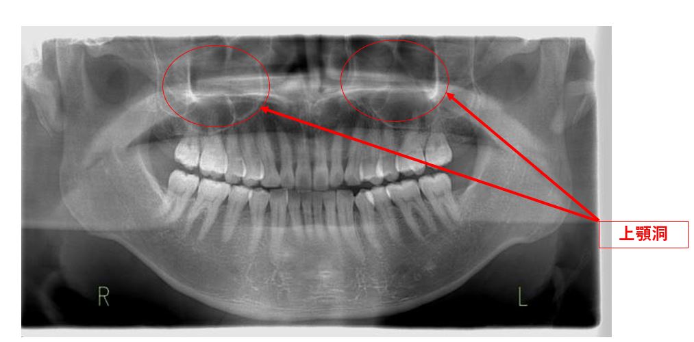 歯性上顎洞炎と副鼻腔炎について