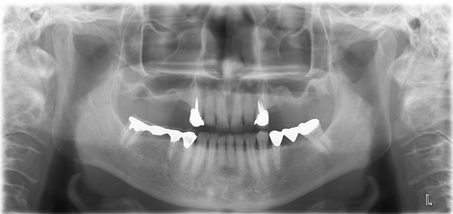 【症例】サイナスリフトテクニック（上顎洞底挙上術）を用いたインプラント治療