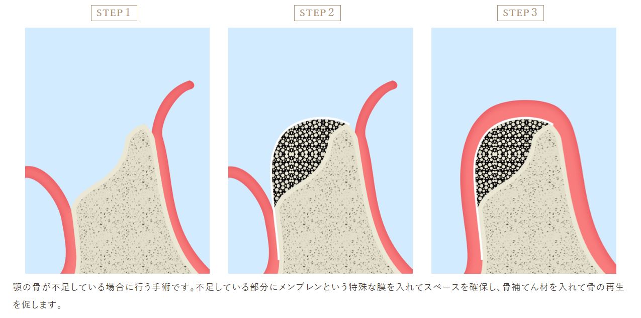 京橋 銀座みらい歯科 骨が足りない場合、インプラントを打つために行う骨造成