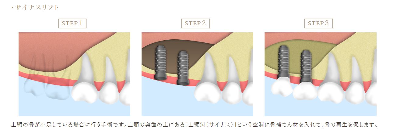 京橋 銀座みらい歯科上顎洞挙上術（サイナスリフト）の手順＿インプラント治療