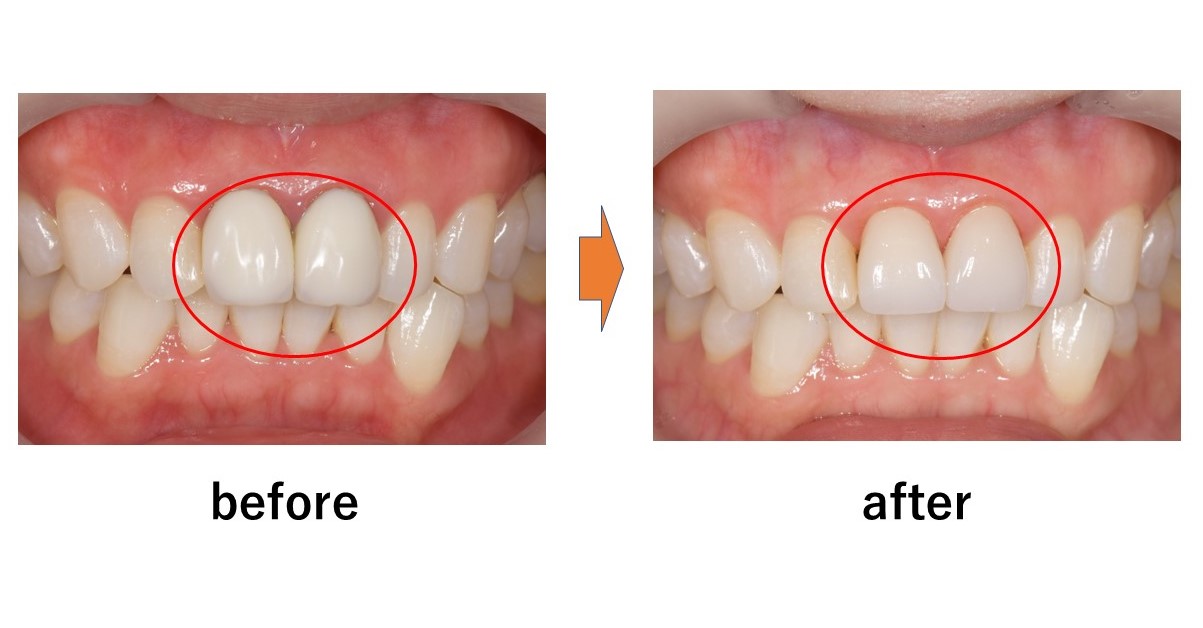 【症例】不自然な前歯に対するジルコニアセラミックでの審美歯科治療