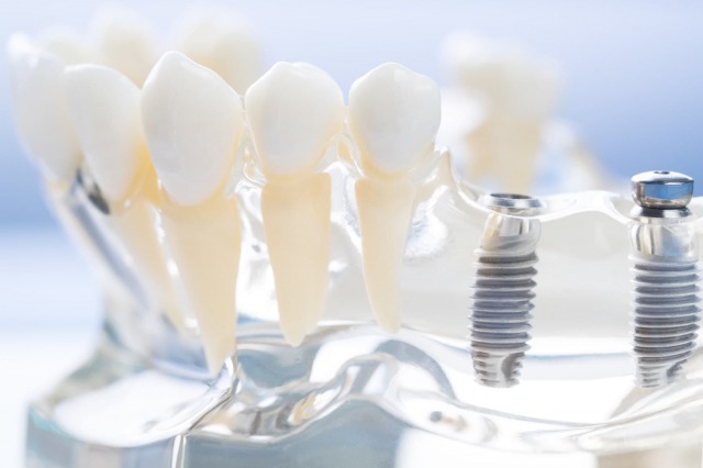 銀座みらい歯科インプラントキャンペーンイメージ画像