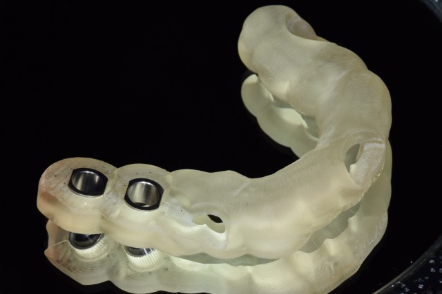 京橋 銀座みらい歯科インプラント治療におけるガイデッドサージェリーの画像１
