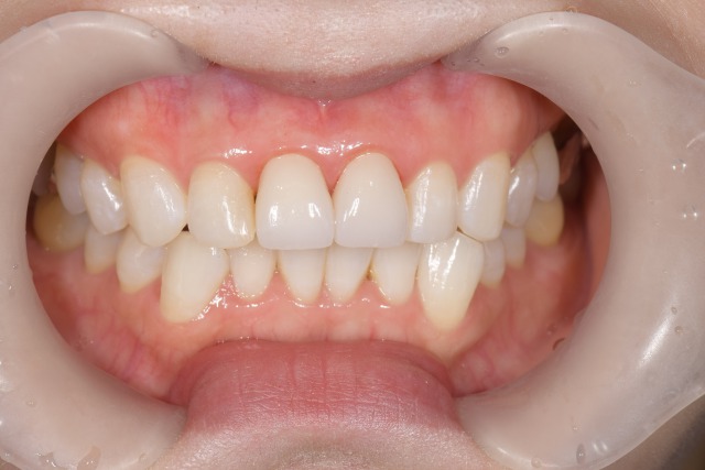 【症例】不自然な前歯に対するジルコニアセラミックでの審美歯科治療