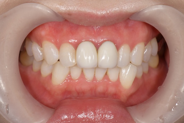【症例】不自然な前歯に対するジルコニアセラミックでの審美歯科治療