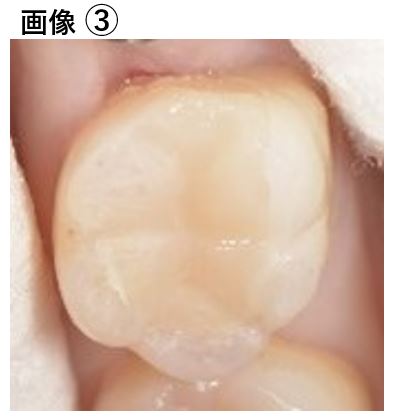 【症例】大きな虫歯に対するMTAセメントを用いた神経温存治療