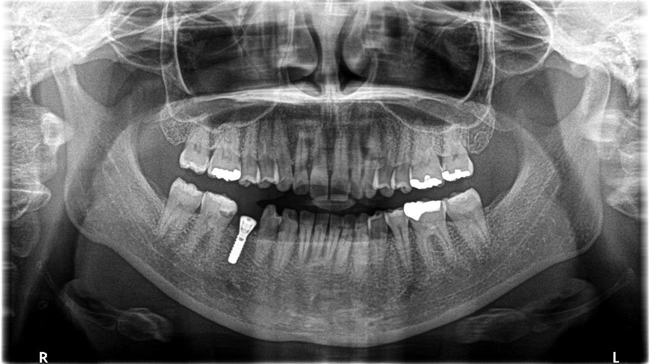 【症例】大きな虫歯に対するMTAセメントを用いた神経温存治療