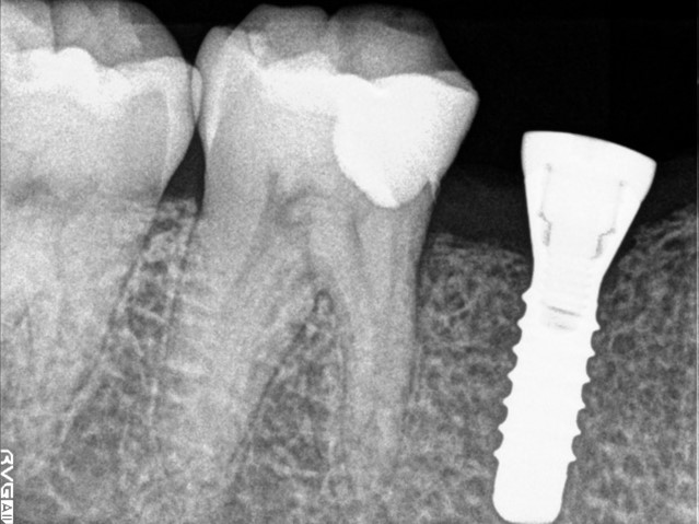 【症例】大きな虫歯に対するMTAセメントを用いた神経温存治療