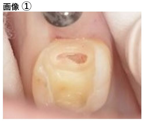 【症例】大きな虫歯に対するMTAセメントを用いた神経温存治療