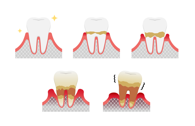 京橋 銀座みらい歯科院長コラム｜噛み合わせの力と歯周病の関係｜歯周病の進行で骨が溶けて歯を失う経過のイラスト