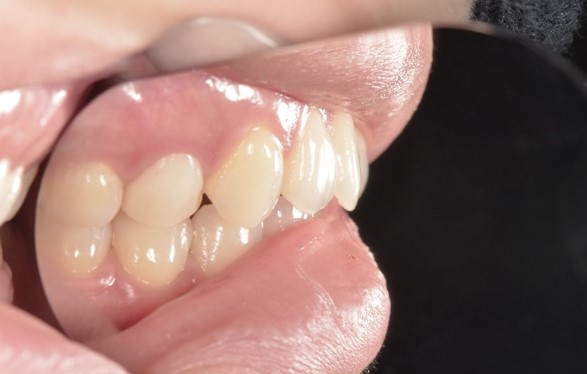 【症例】審美歯科領域におけるジルコニアセラミック修復