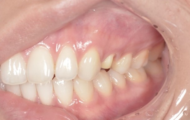 【症例】審美歯科領域におけるジルコニアセラミック修復