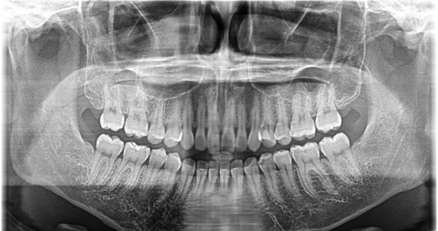 【症例】明るい色調の歯に対するホワイトニング