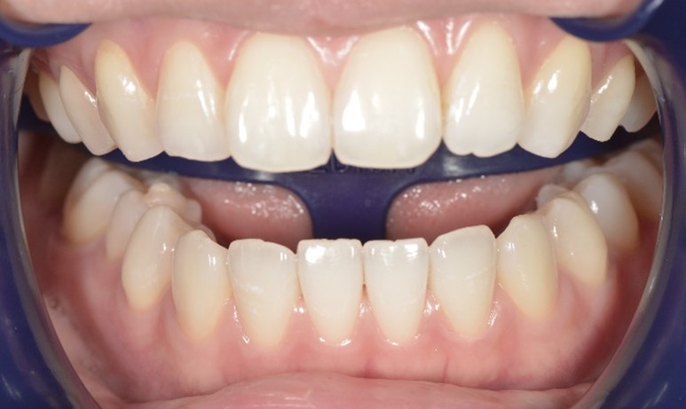 【症例】明るい色調の歯に対するホワイトニング