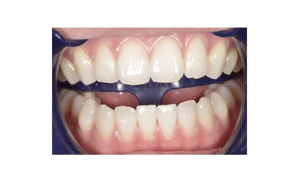 【症例】明るい色調の歯に対するホワイトニング