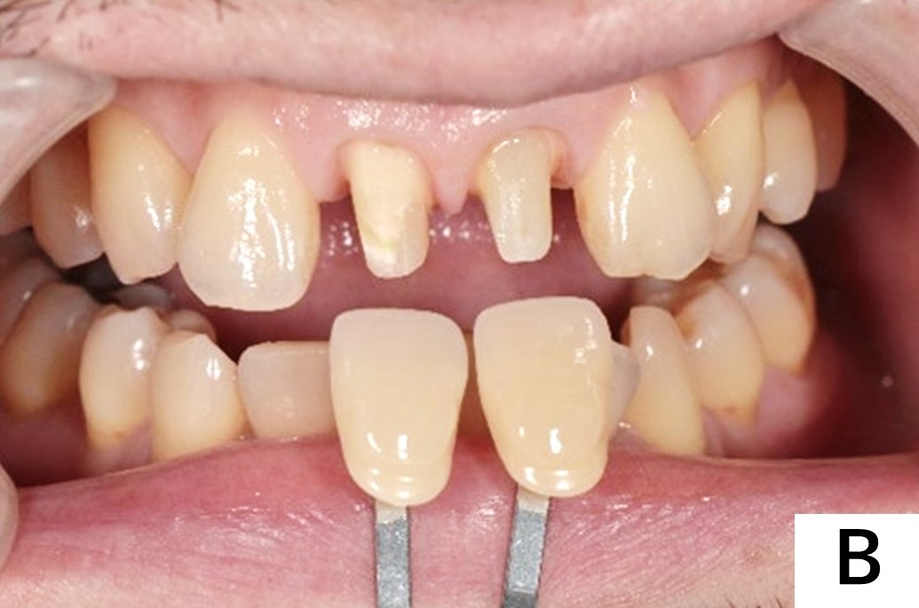 【症例】神経のない前歯の変色に対するジルコニアセラミックでの審美治療