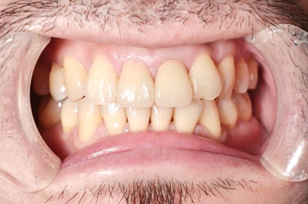 【症例】神経のない前歯の変色に対するジルコニアセラミックでの審美治療