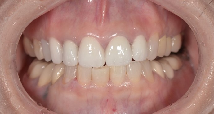 【症例】前歯の変色や形へのストレスを解決するジルコニアセラミックによる審美治療