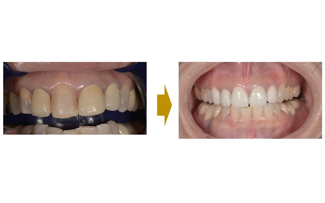 【症例】前歯の変色や形へのストレスを解決するジルコニアセラミックによる審美治療