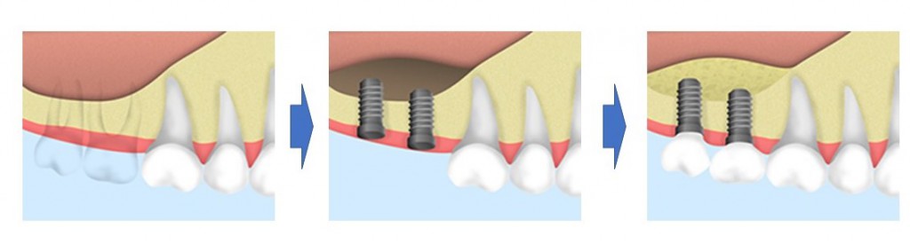 京橋 銀座みらい歯科｜歯科医師ブログ｜上顎のインプラント治療におけるソケットリフトとサイナスリフト｜サイナスリフトの流れ図