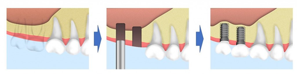 京橋 銀座みらい歯科｜歯科医師ブログ｜上顎のインプラント治療におけるソケットリフトとサイナスリフト｜ソケットリフトの流れ図