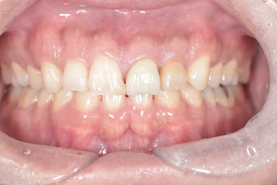 【症例】前歯部のジルコニアセラミック治療で見た目を改善