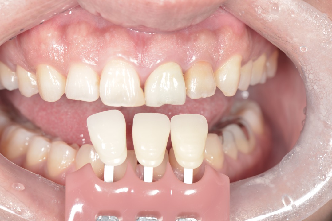 【症例】前歯部のジルコニアセラミック治療で見た目を改善