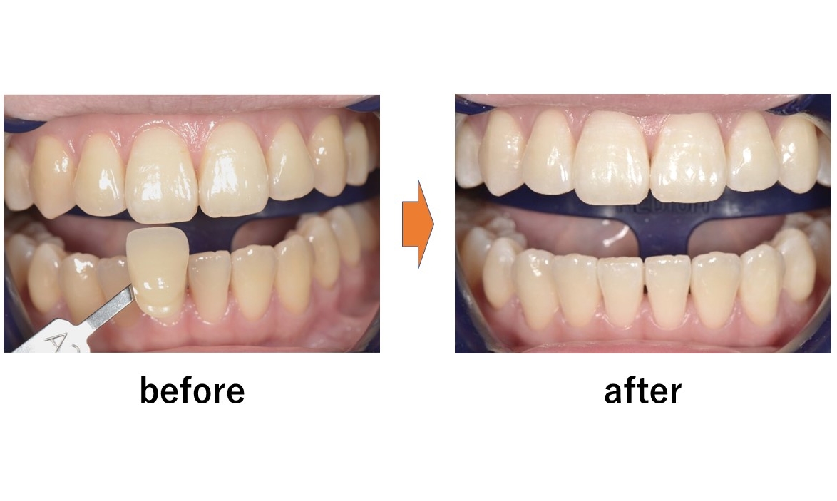 【症例】黄色みの強い歯に対するホワイトニング