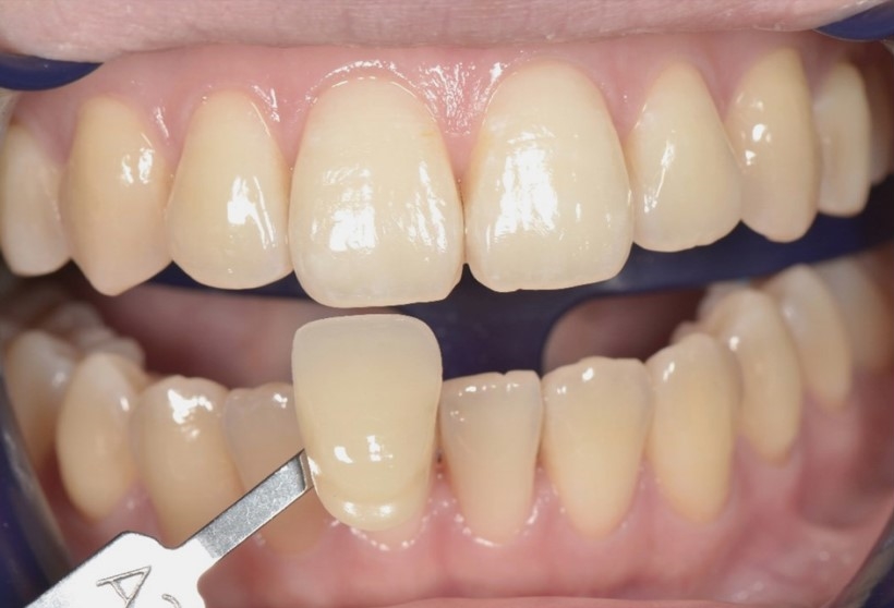 【症例】黄色みの強い歯に対するホワイトニング