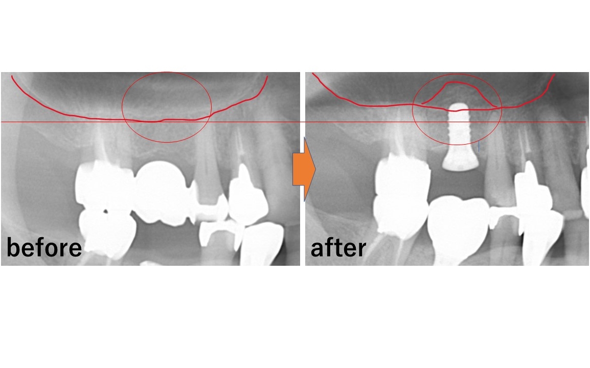 【症例】ソケットリフト（オステオトームテクニック）によるインプラント治療