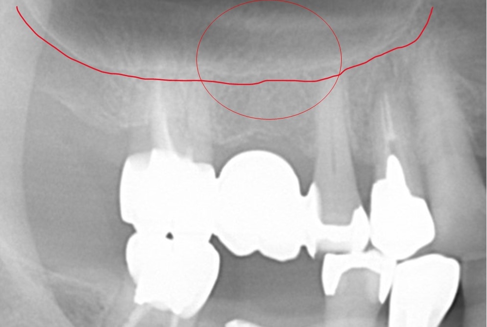 【症例】ソケットリフト（オステオトームテクニック）によるインプラント治療｜治療前レントゲン画像｜京橋 銀座みらい歯科症例